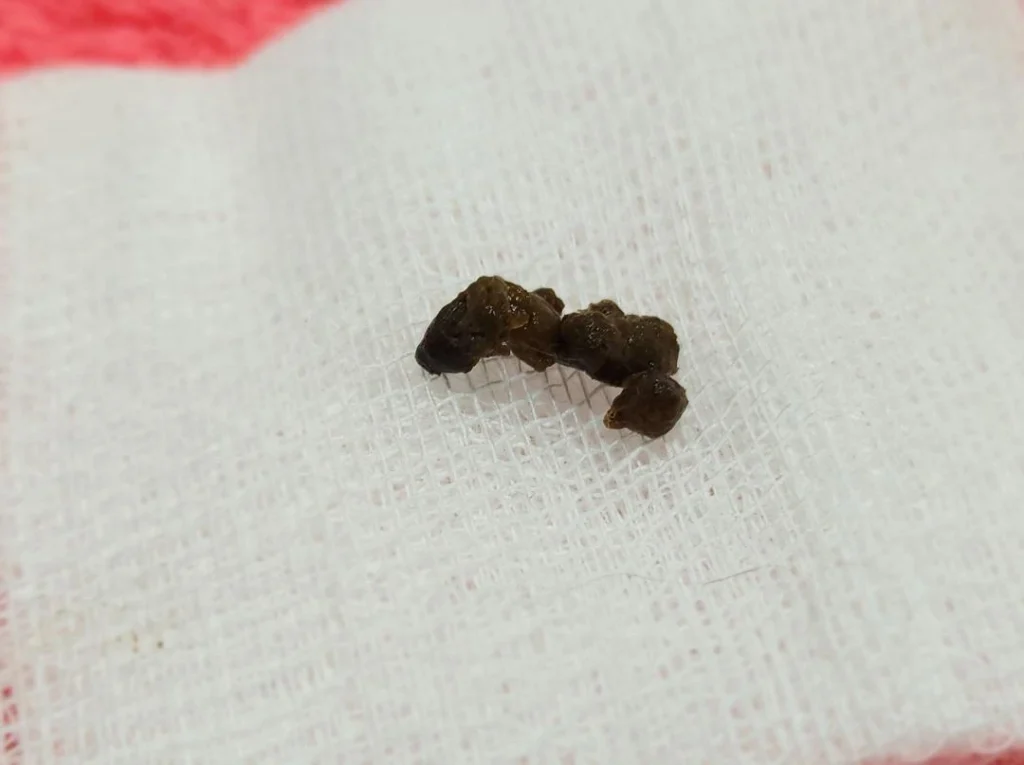 ตัวอย่างอุจจาระปกติ