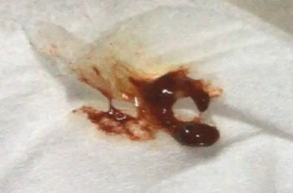 อุจจาระเหลว เป็นมูก